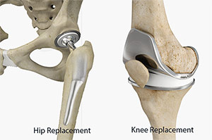 What to Know About Hip and Knee Replacements