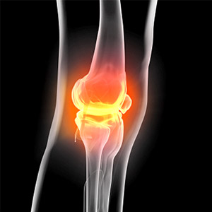 Study dispels myth of exercise damage in the treatment of osteoarthritis of the knee.