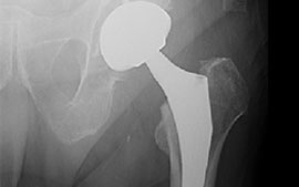 Modularity in Total Hip Arthroplasty: Benefits, Risks, Mechanisms, Diagnosis, and Management
