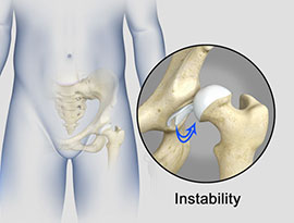 Understanding hip instability helps orthopedists perform revision THA