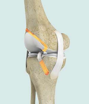 Young athletes who require ACL reconstruction may benefit from additional procedure