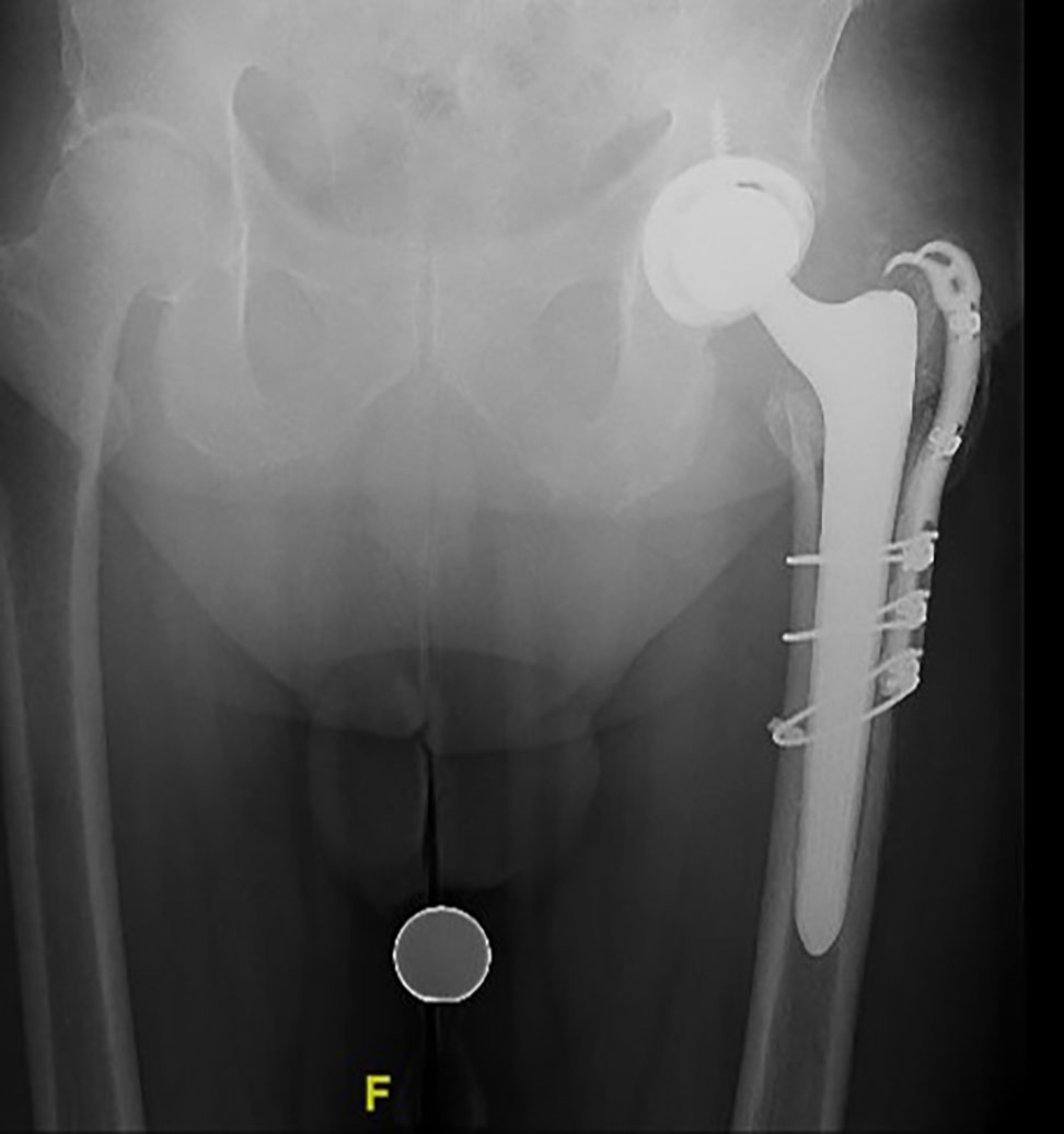 Revision Total Hip Replacement