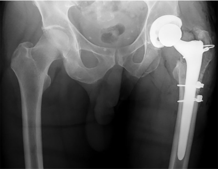 Hip and Knee Replacement Parts and Materials - Stephen J. Incavo, MD